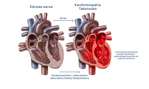 Zdrowe serce kontra kardiomiopatia Takotsubo, czyli zespół złamanego serca. Stres powoduje zmianę kształtu lewej komory.