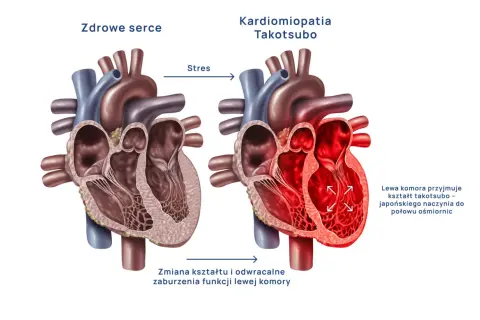 Zdrowe serce kontra kardiomiopatia Takotsubo, czyli zespół złamanego serca. Stres powoduje zmianę kształtu lewej komory.