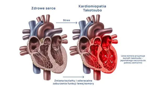 Zdrowe serce kontra kardiomiopatia Takotsubo, czyli zespół złamanego serca. Stres powoduje zmianę kształtu lewej komory.